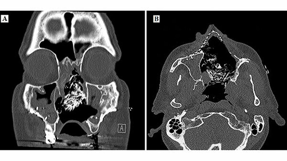 Abbildung 5: Computertomografie A = coronale Schicht, B = axiale Schicht: Zustand nach Resektion, Osteosynthesematerial und Iodoformtamponade in situ