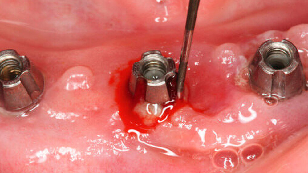 Abbildungen 1a: Klinische und intraoperative Charakteristika einer etablierten Periimplantitis (BOP und Pus+, Pocketing, kombiniert suprakrestaler und circumferentieller Knochenabbau)