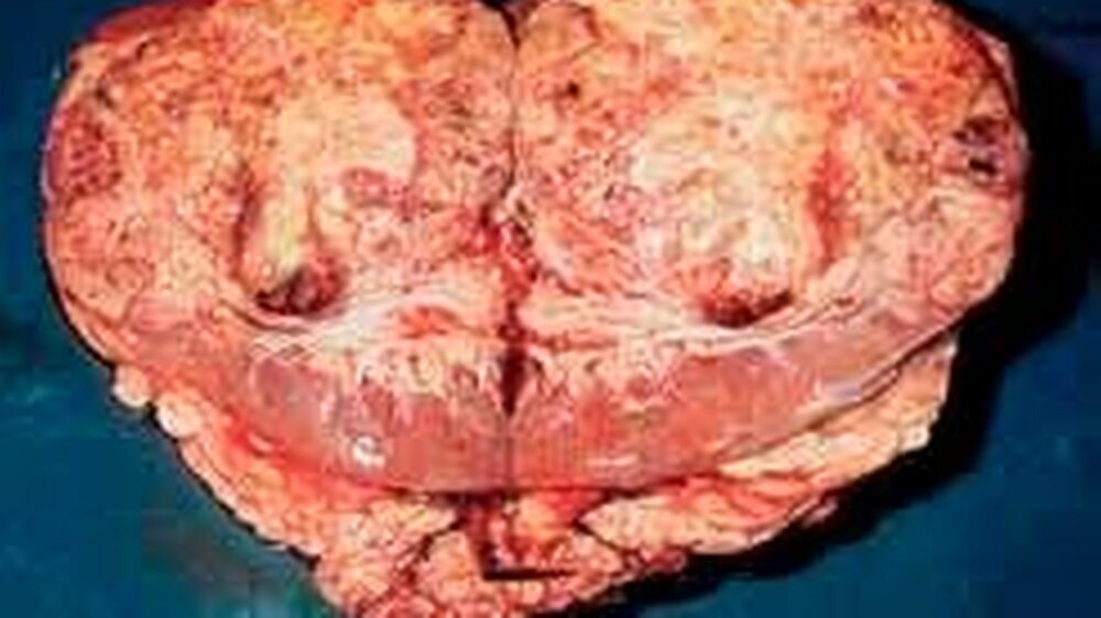 Resektat eines Nierenzellkarzinoms