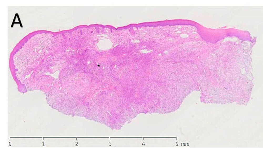 Abbildung 5a: Übersicht der Biopsieentnahme aus dem Bereich des Alveolarkamms mit einem subepithelialen Tumor |