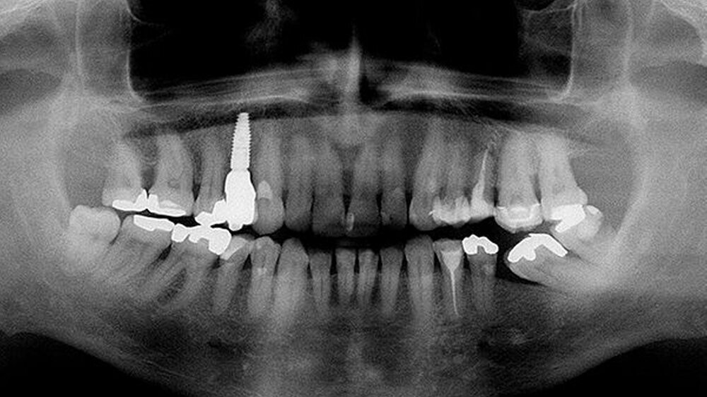 Röntgendiagnostik des prothetisch versorgten Implantats regio 14