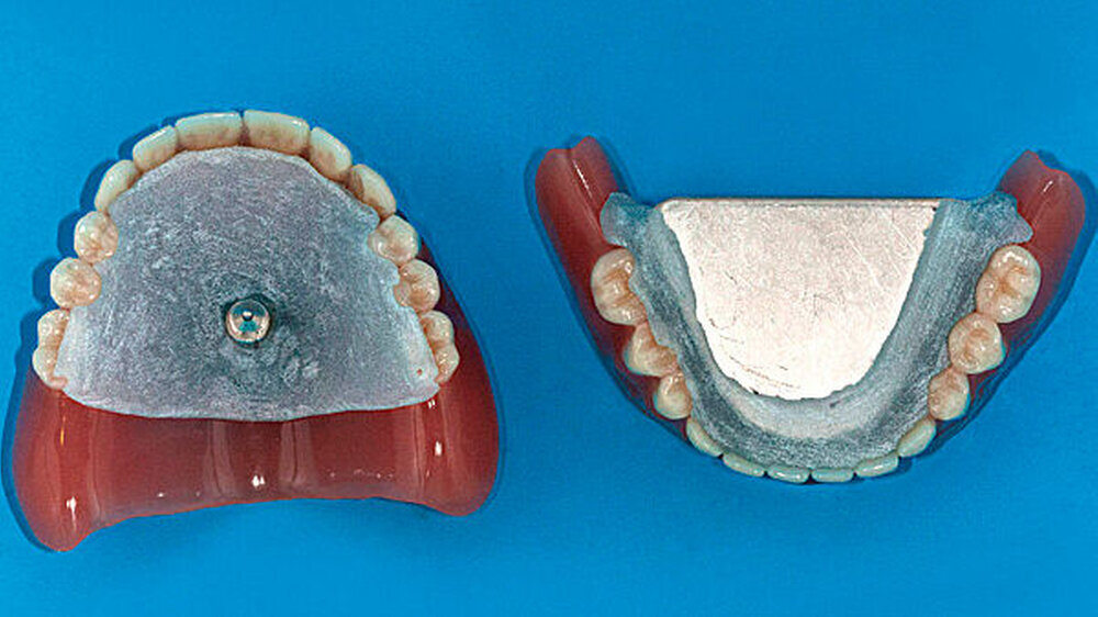 Abbildung 1: Übliche Stützstiftplatten im Ober- und Unterkiefer, wenn mit dem Condylator®-System registriert wird. Abbildung 1: Übliche Stützstiftplatten im Ober- und Unterkiefer, wenn mit dem Condylator®-System registriert wird.