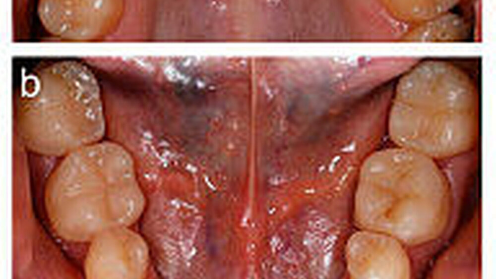 Abbildung 10: Abschlussbilder nach der Restauration: a: Oberkiefer, b: Unterkiefer, c: Frontzahnsituation |