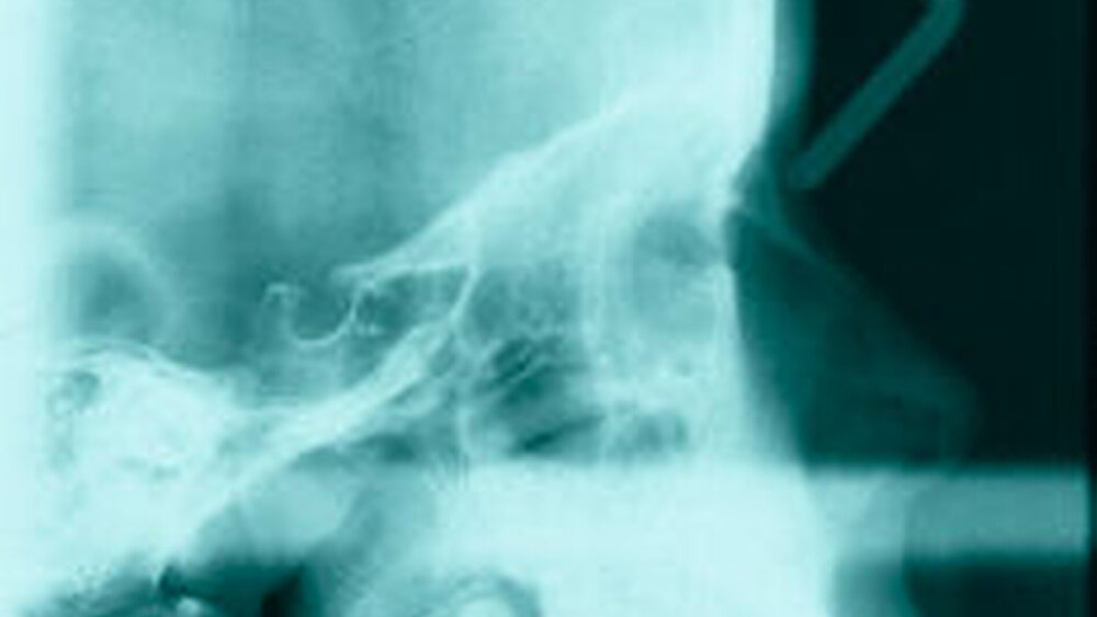 Abbildung 1 d: Trotz voranschreitendem Abbau des rechten Kondylus ist das FRS noch unauffällig. |