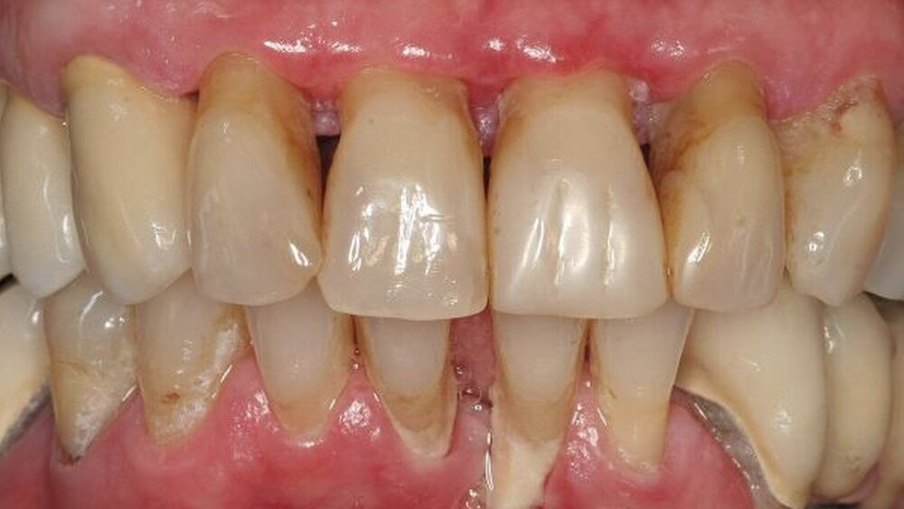 Abbildung 2: Fortgeschrittene Parodontitis und massiv supragingivale Plaque: mögliche Quelle flüchtiger Schwefelverbindungen und damit von Halitosis. |