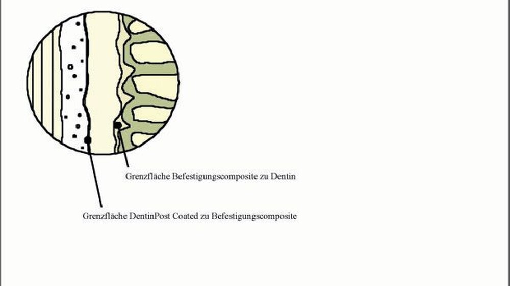 Abbildung 1: Grenzflächen Stift-Composite- Dentin