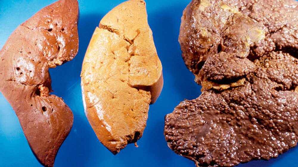 Drei Zustände der Leber: links gesund, Mitte Fettleber, rechts Leberzirrhose Drei Zustände der Leber: links gesund, Mitte Fettleber, rechts Leberzirrhose