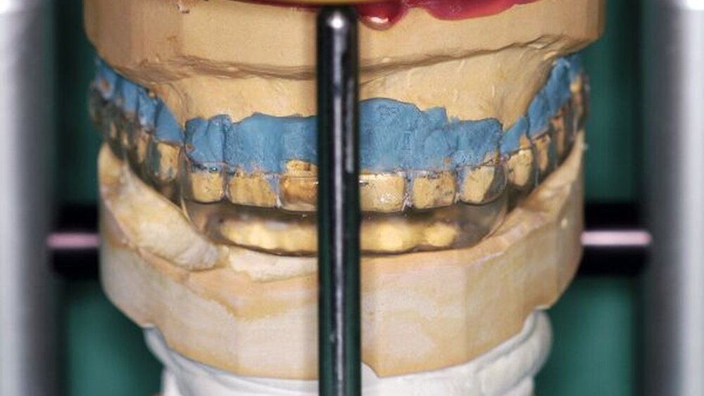 Abbildungen 10a, 10b: Okklusal adjustierte Stabilisierungsschiene. |