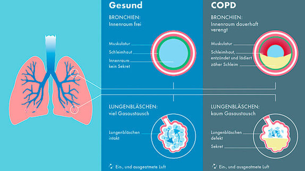 Es wird geschätzt, dass derzeit rund zehn bis sogar zwölf Prozent der über 40-Jährigen hierzulande an einer COPD leiden. Damit ist die COPD häufiger als Asthma, Pneumonien und ein Bronchialkarzinom zusammengenommen.