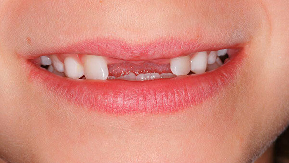 Abbildungen 13 bis 15: Behinderung und deutliche Verzögerung der normalen Eruption der zentralen Inzisiven im Oberkiefer aufgrund überzähliger Zähne (11+ und 21+) bei einer knapp neunjährigen Patientin (14: extraorale Ansicht).  |