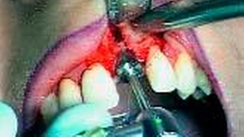 Die richtige Behandlungsstrategie ist ein entscheidender Faktor für den Erfolg bei der Versorgung mit Implantaten.