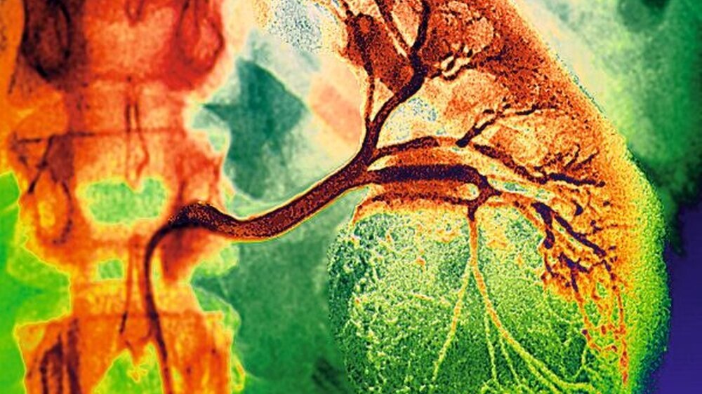 Ein Nierentumor bei einer 23-jährigen Frau – dokumentiert in der Nieren-Angiographie