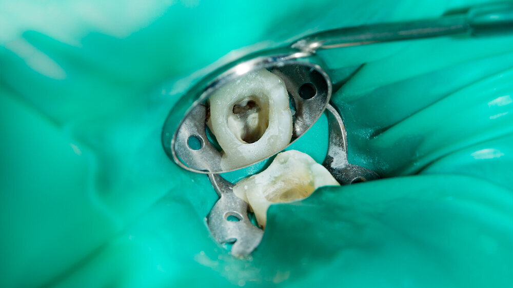 treatment and restoration of rotten carious tooth after root canal filling endocanal pins from fiberglass and photopolymer sealing material Wurzelkanalbehandlung