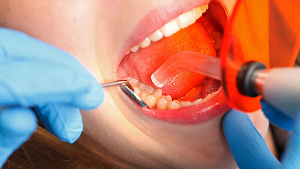Kompositfüllungen weisen zwar im Laufe der Jahre häufig kleinere Mängel oder ästhetische Einschränkungen auf. Eine vollständige Entfernung ist aber nicht immer notwendig – häufig reicht auch eine Reparatur.