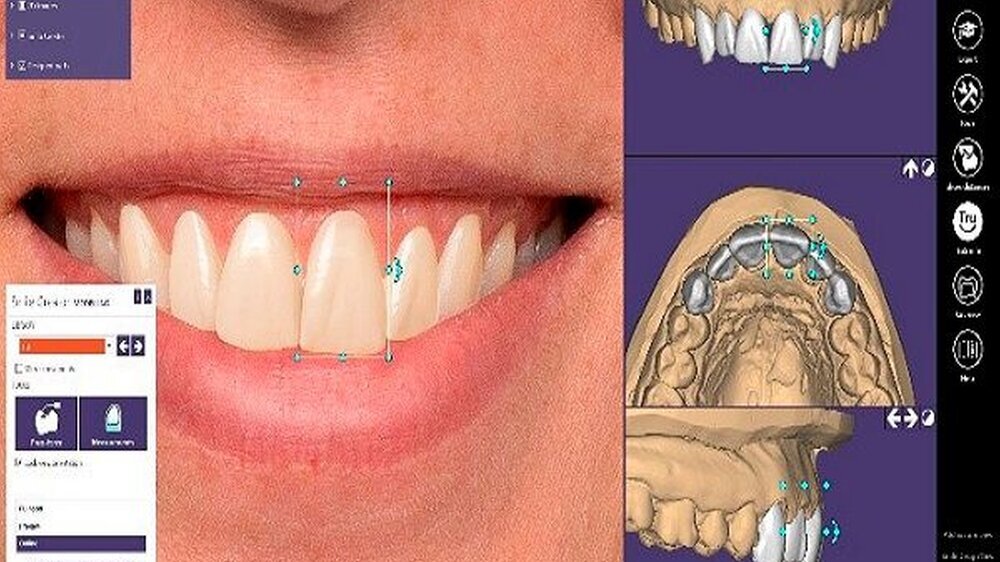 exocads ChairsideCAD ist eine offene und geräte- sowie herstellerneutrale CAD/CAM-Software für das klinische Umfeld. Mit dem neuen Add-on Modul Smile Creator, das ab sofort mit ChairsideCAD 2.3 Matera verfügbar ist, lassen sich hochästhetische Restaur