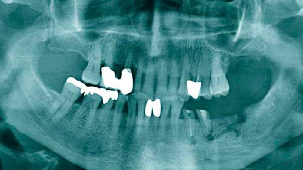 Abbildung 2: Panoramaschichtaufnahme einer Patientin, die auf Basis einer myeloproliferativen Erkrankung und unabhängig hiervon wegen einer Osteoporose noch ein zweites Bisphosphonat verschrieben bekommen hatte: Die Nekrose befand sich im Unterkiefer links bei Z.n. Wurzelspitzenresektion und Implantation. Gut zu erkennen sind aber die typischen Nekrose-unabhängigen Bisphosphonat-induzierten Veränderungen im Röntgenbild. Durch die Sklerosierung der Trabekel entstand ein honigwabenartiges Muster des Knochens, das im Bereich des Alveolarkamms zu erkennen ist. Ebenfalls ist die Kortikalis des Unterkiefers weiter nach cranial verschoben. Der Kanal des Nervus alveolaris inferior kommt durch die Sklerosierung ebenfalls viel stärker zur Darstellung. Vereinzelt kann man die Lamina dura gut erkennen (Unterkiefer rechts), partiell kommen erweiterte Parodontalspalten zur Darstellung.
