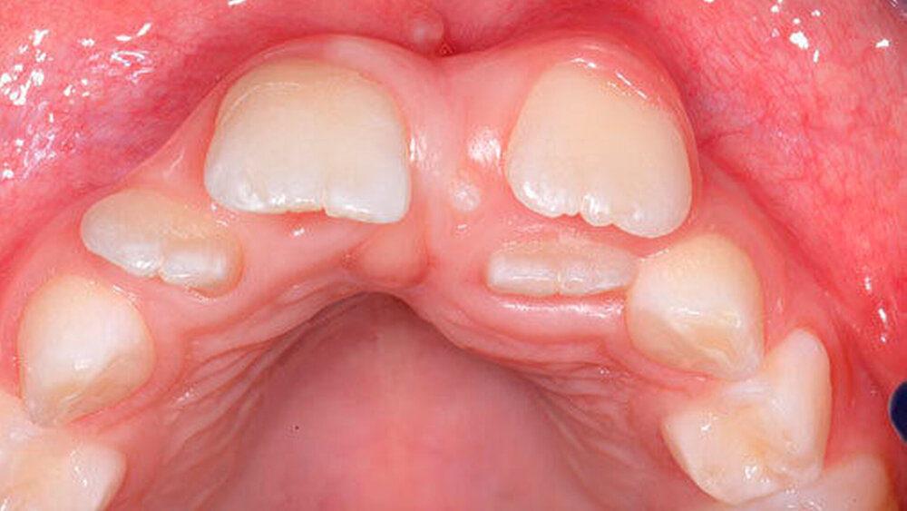 Abbildungen 16 und 17: Rotation und Lageverschiebung der Oberkieferschneidezähne sowie ein ausgeprägtes Diastema centrale aufgrund eines teils durchgebrochenen Mesiodens bei einem achtjährigen Patienten (17: okklusale Ansicht). |