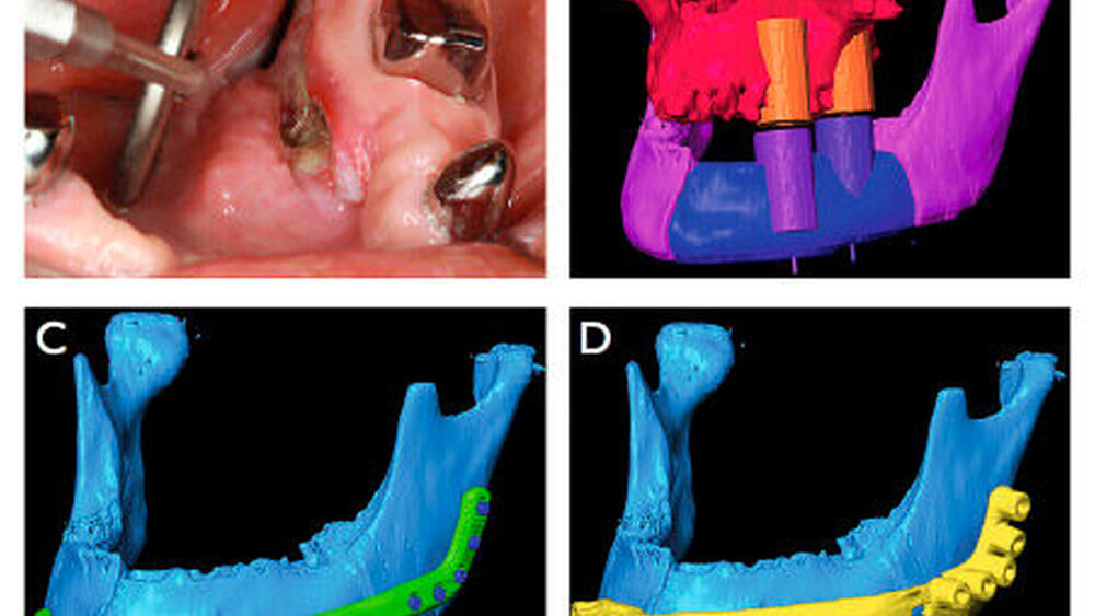 Abbildung 4: Patientin mit einem PEC lingual regio 36 (A); simulierter Unterkiefer Zustand nach Kontinuitätsresektion (rosa) und simulierter Knochenersatz (blau), Hohlzylinder im OK und im UK zur Simulation der dentalen Implantate (B); importierte Rekoplatte (PSMP-Synthes®) (grün) und Schrauben (blau) entlang des neu rekonstruierten virtuellen CAD-Unterkiefers (hellblau) (C); virtuell hergestellte Bohr- und Resektionsschablone (gelb) (D) |