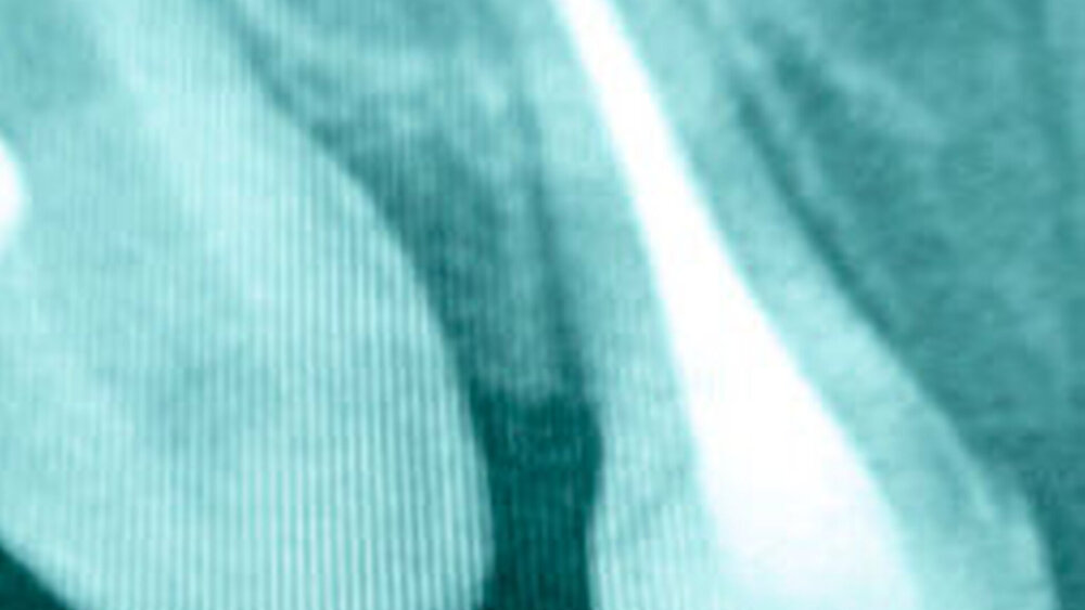 Abbildung 2: Milchzahnendodontie an Zahn 52 eines dreijährigen Jungen mittels einer resorbierbaren Calciumhydroxid-Iodoform-Paste (Vitapex©, Neo-Dental Inc, Richmond Hill, Canda) |