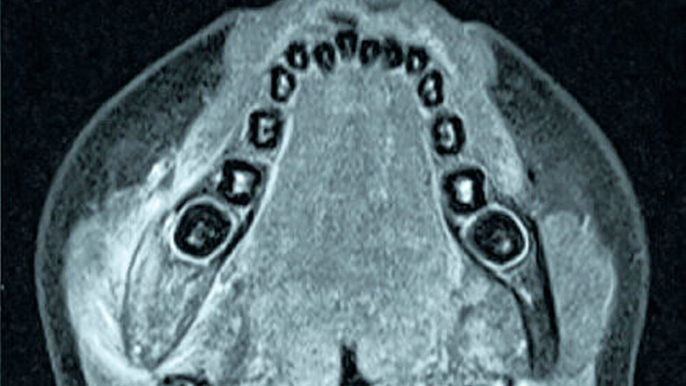 Abbildung 4: Kernspintomografie der gleichen Patientin von Abbildung 3 zum Zeitpunkt der Panoramaschichtaufnahme in A: deutlich verdickte Darstellung des rechten Unterkiefer-Korpus im Kieferwinkelbereich mit Flüssigkeitssignal im Sinne eines entzündlichen Knochenmarksödems und entzündlicher Umgebungsreaktion der Muskulatur. |