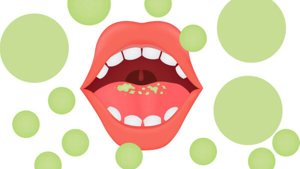 Das Küssen und Geküsst werden ist nicht für jedermann ein fröhliches Ereignis. Denn, Mundgeruch kann zum Liebestöter werden. Studien zeigen, dass in Europa jeder Vierte von Mundgeruch (Halitosis) betroffen ist.