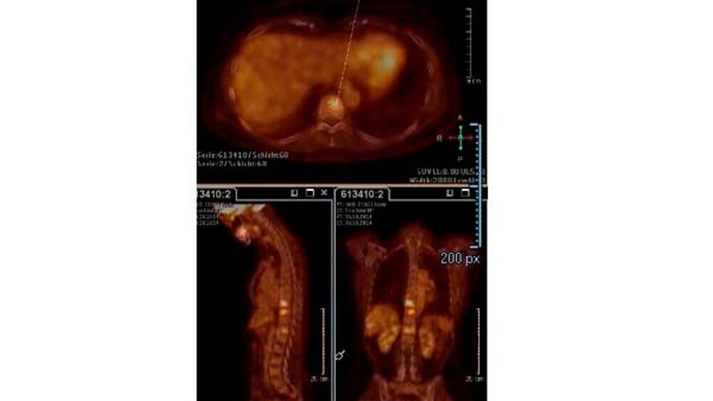 Die PET-CT-Aufnahme zeigt den metastatischen Befall an der Wirbelsäule (leuchtende Stellen).