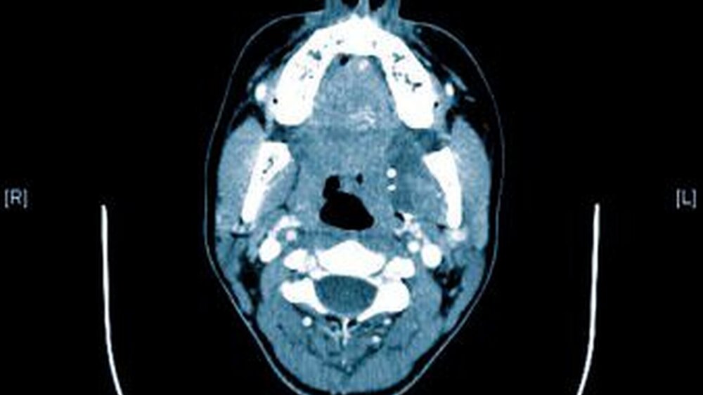 Abbildung 6: Phlebolithen in einer großen venösen Malformation in der linken Mastikatorloge |