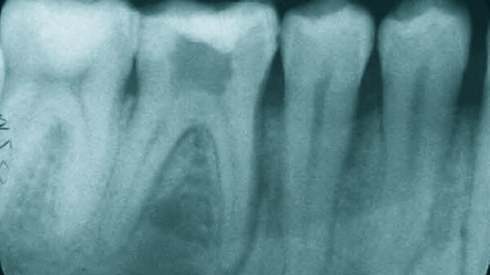 Abbildung 1: Zahnfilm 44-47: Apikale Aufhellung, erweiterter PA-Spalt und interradikuläre Osteolyse an Zahn 46