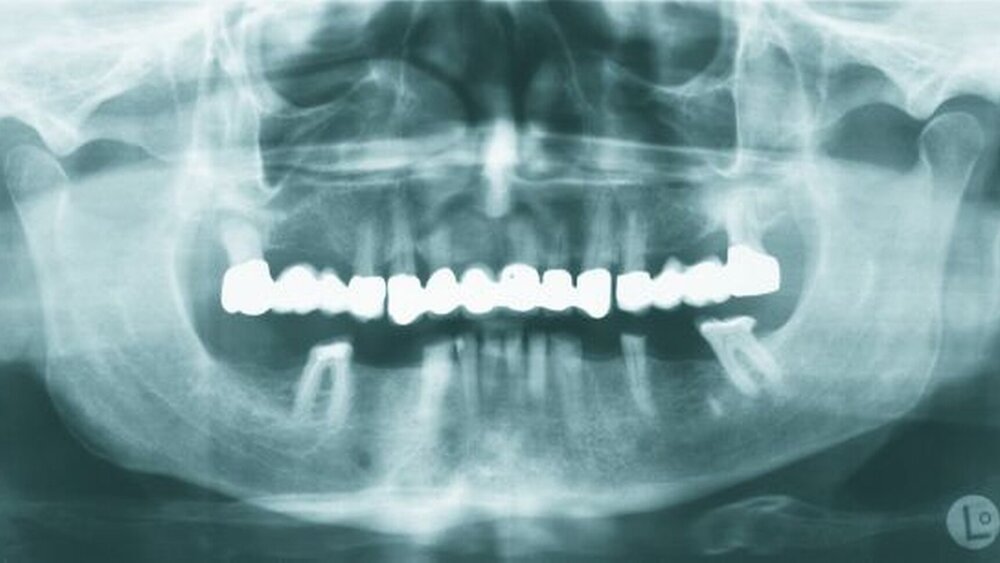 Abbildung 2: Orthopantomogramm vom 29.04.2008. |