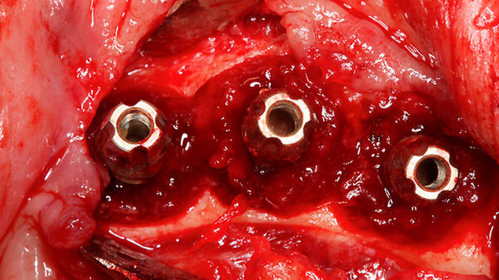 Intraoperative Darstellung der typischen cirucumferentiellen knöchernen Defekte |