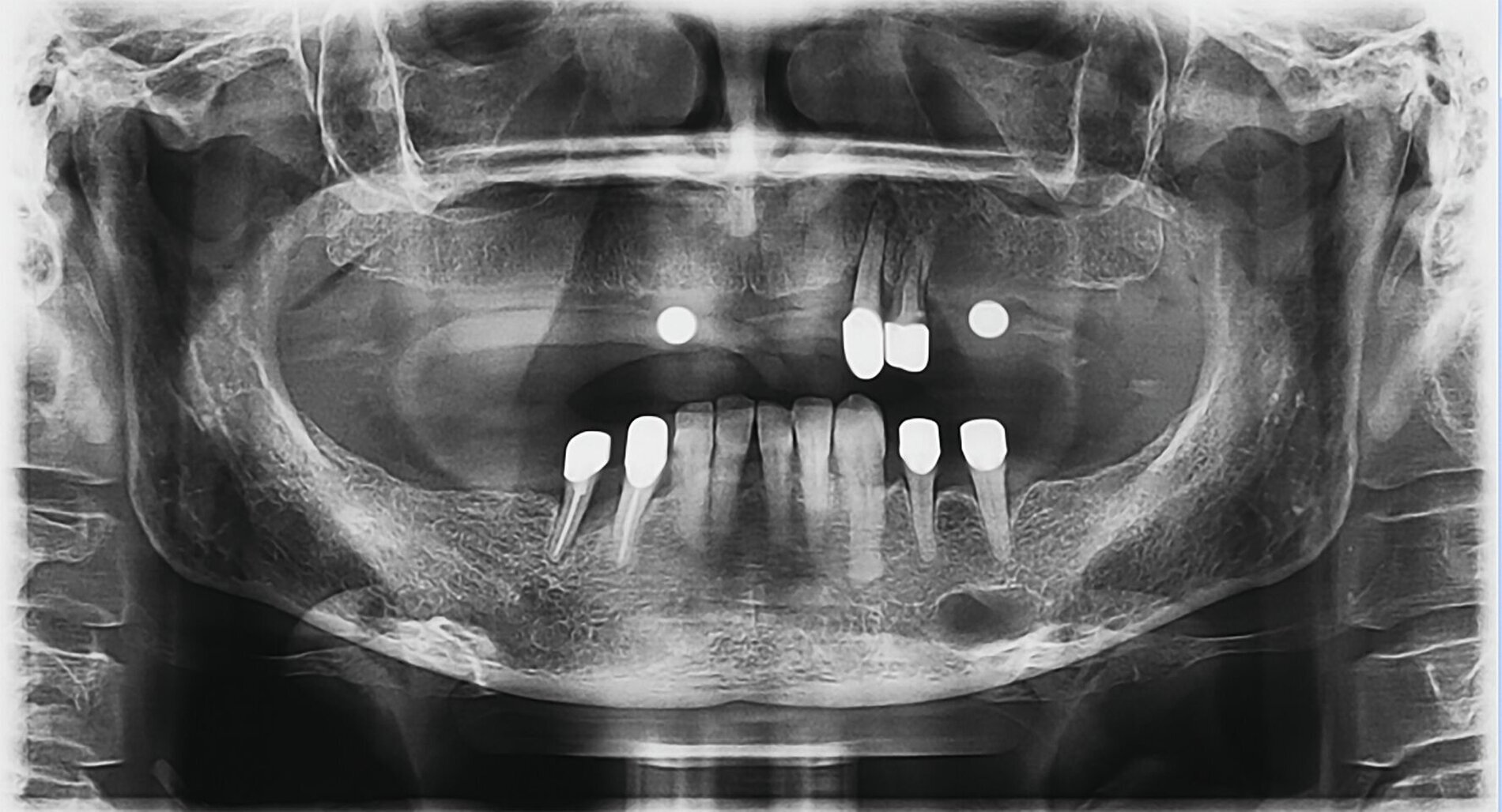 Vaskuläre Anomalie am Foramen mentale