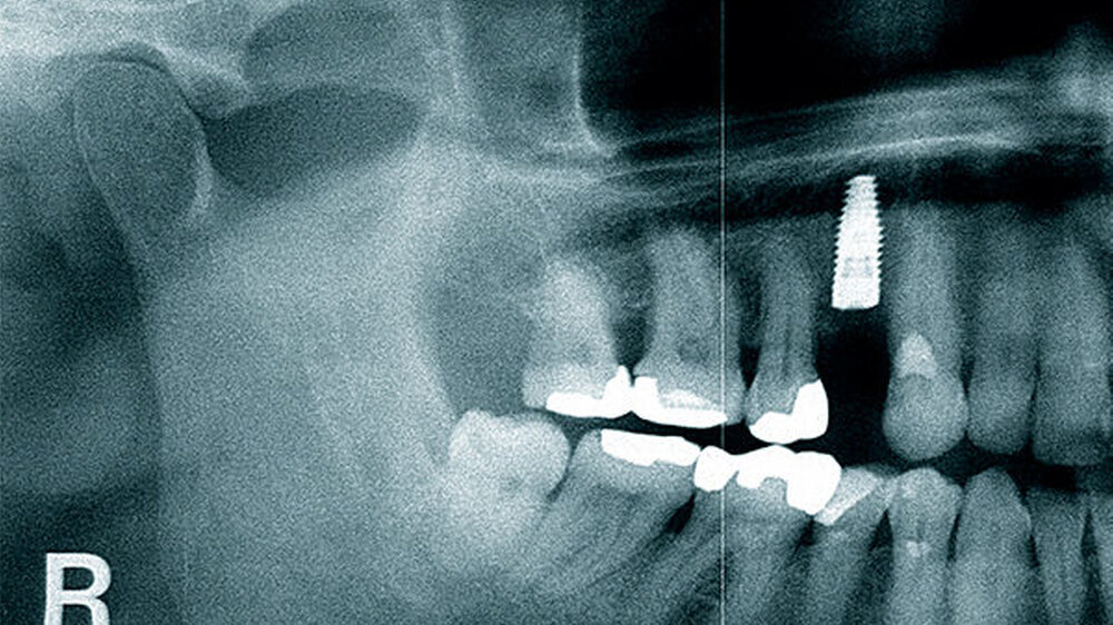 Radiologische Kontrolle nach Implantatinsertion (Straumann BLT 4,1 mm × 12 mm, Basel, Schweiz)