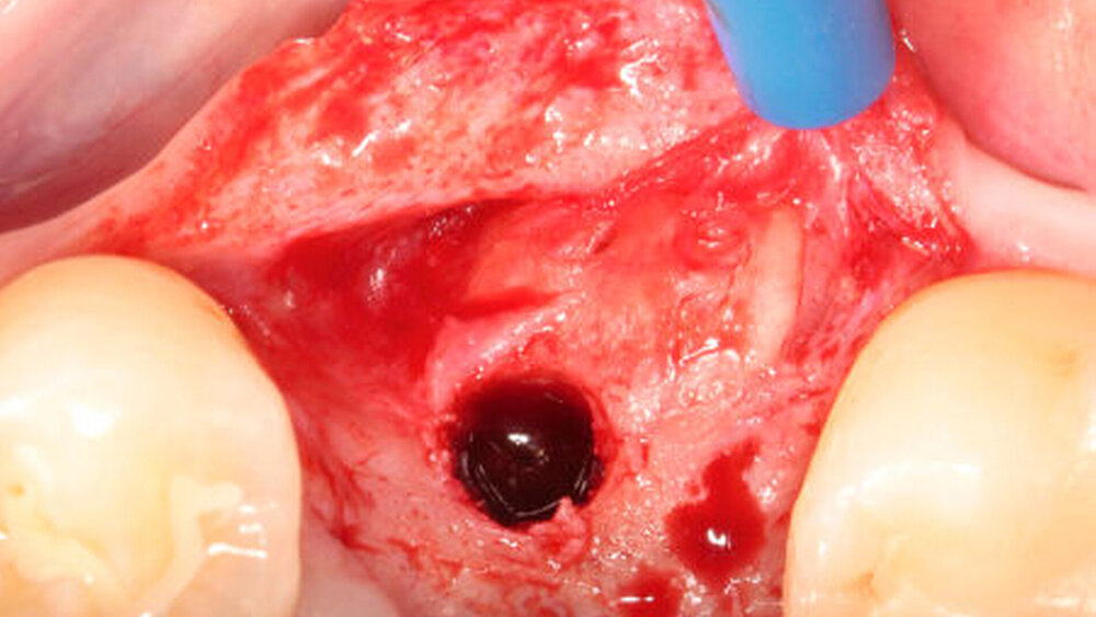 Abbildung 5b: Die Verbreiterung des Kieferkamms ermöglichte die Implantatinsertion in einer prothetisch günstigen Position. |