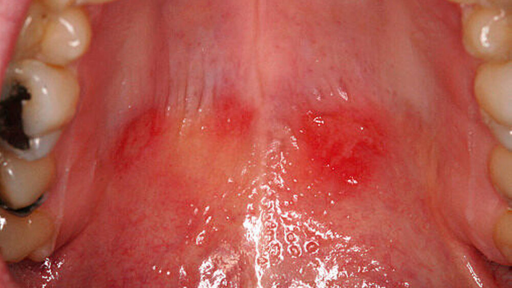 Abbildung 1: Orale Manifestationder Hand-Fuß-Mundkrankheit als aphthoide Veränderungam Gaumen (Patient männlich, 36 Jahre) |