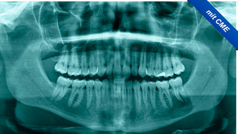 Abbildung 1: Präoperatives OPTG: Eine scharf begrenzte Osteolyse im Bereich der linken Unterkieferseitenzähne von Zahn 37 bis 36 ohne Verdrängung oder Resorption der im Befund stehenden Wurzeln. | Abbildung 1: Präoperatives OPTG: Eine scharf begrenzte Osteolyse im Bereich der linken Unterkieferseitenzähne von Zahn 37 bis 36 ohne Verdrängung oder Resorption der im Befund stehenden Wurzeln. |