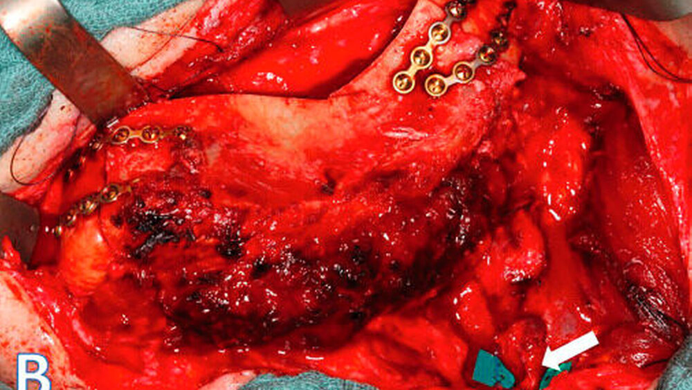 Abbildung 6b: Das in situ anastomosierte (weißer Pfeil) und fixierte Transplantat |
