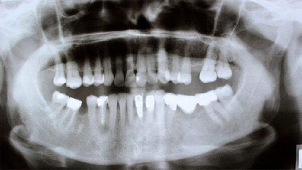 Abbildung 3: Das OPG am Tag der Erstvorstellung zeigt keine dentalen oder ossären Auffälligkeiten im Hinblick auf die bestehende Klinik nach dem Spülzwischenfall.\r\n
