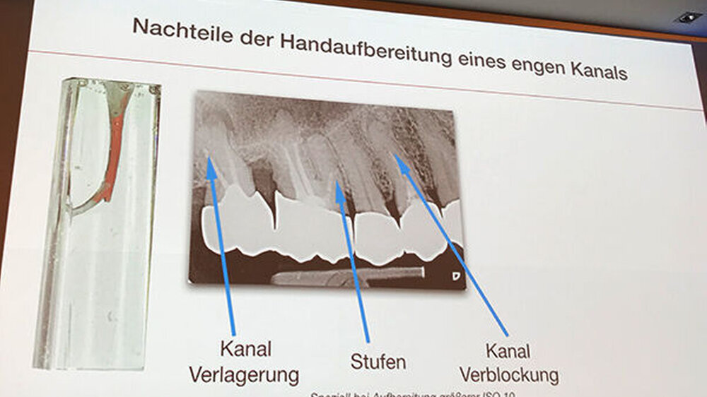 Dr. Christoph Zirkel, Köln, diskutierte den Unterschied zwischen der Aufbereitung des Wurzelkanals mittels Handgeräten und einer elektrischen Aufbereitung. Vorteile der Handaufbereitungen speziell im engen Kanal sind für ihn eine bessere Taktilität so