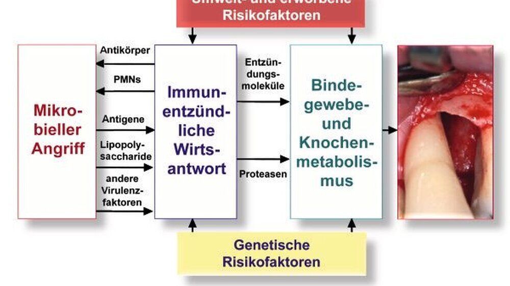 Abbildung 1: Ätiopathogenese der Parodontitis (modifiziert nach Page & Kornman, 1997)