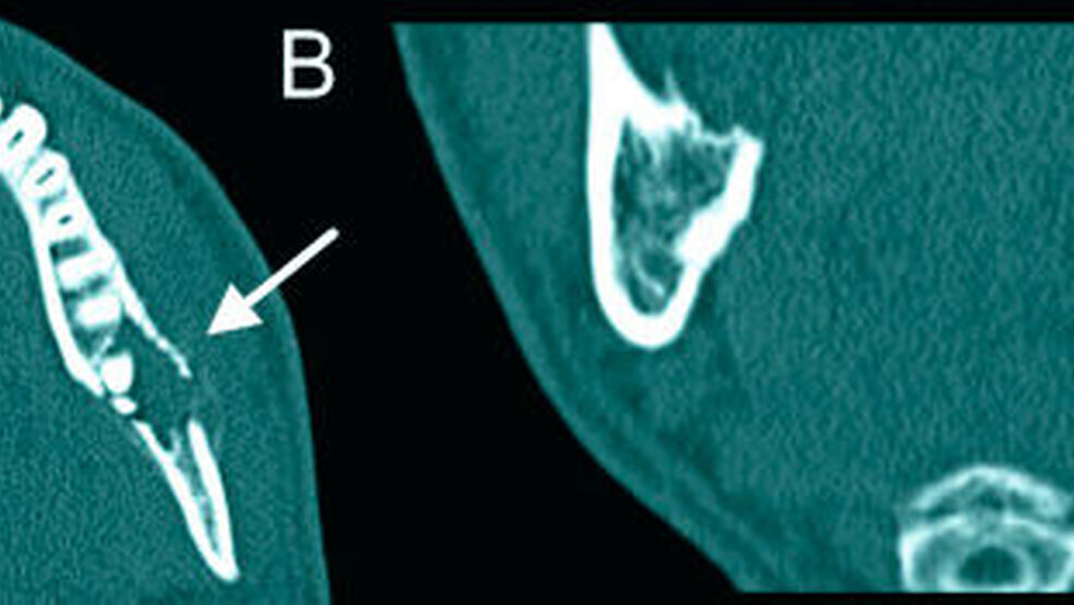Abbildung 2: Präoperativer CCT-Befund: Im CCT (A: axial Knochenfenster; B: coronares Knochenfenster) stellt sich eine scharf begrenzte, überwiegend homogen strukturierte, osteolytische Raumforderung mit Perforation der vestibulären Kompakta dar (Pfeil). |