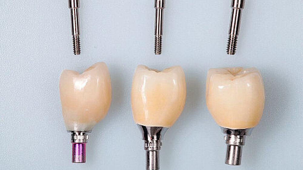 Abbildung 2: Das Implantat 14 (l.) wurde mit einem direkt verblendeten Zirkonoxidgerüst und Titanklebebasis versorgt. Implantat 15 (m.) und Implantat 16 (r.) wurden aus Gründen der maximalen Stabilität mit monolithischen Lithium-Disilikatkronen auf individuell gefertigten Titanabutments verklebt. Aufgrund der nur knapp eingehaltenen Mindestabstände zwischen den Implantaten wurde die Krone 15 mit Plattformswitching hergestellt. Alle Kronen wurden okklusal verschraubt. |