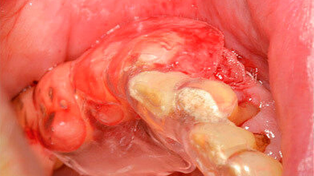 Abbildung 5: Verbandsplatte in situ |