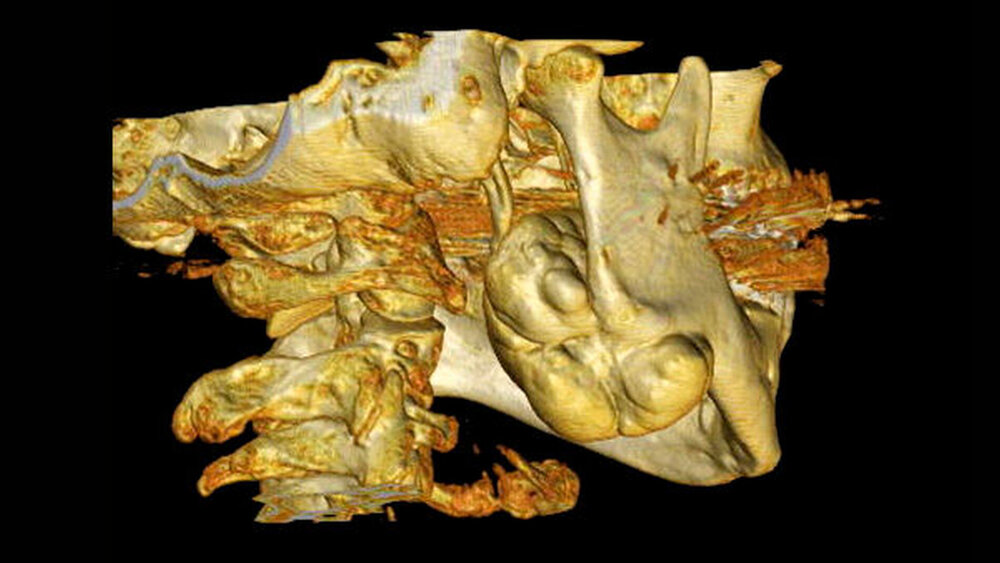 Abbildung 3: Dreidimensionale Rekonstruktion (4,4 x 3,3 x 4,7 cm) |