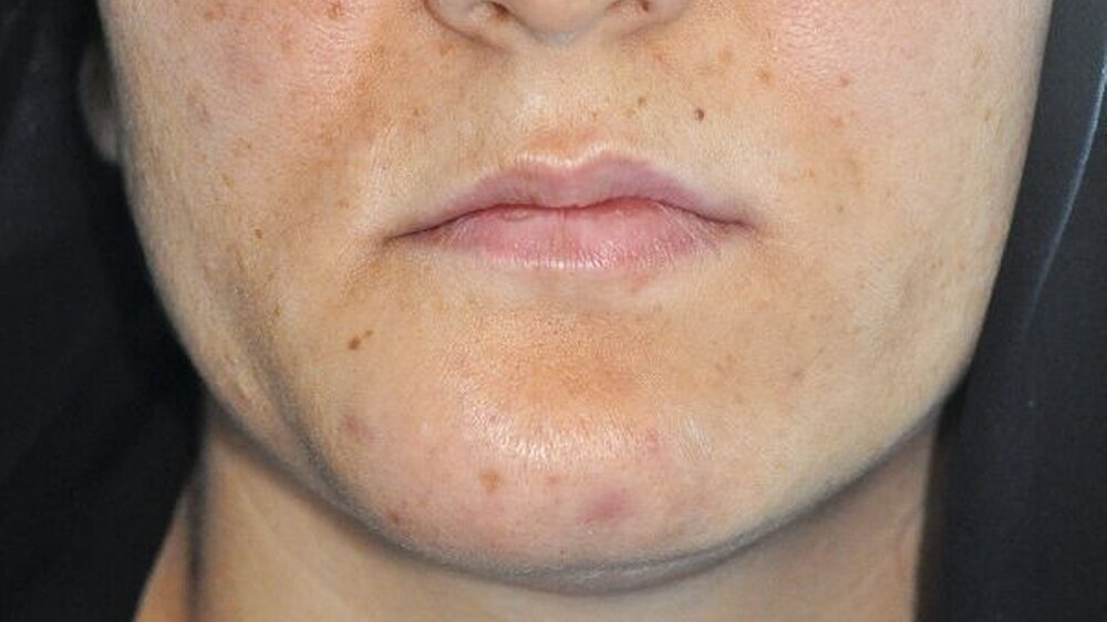 Abbildung 1: klinisches Bild der 20-jährigen Patientin mit äußerlich erkennbarer Schwellung im Bereich des Kinns rechts