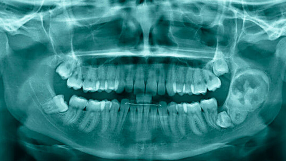 Alio Ioco angefertigte Panoramaschichtaufnahme mit einer knapp 3cm x 5cm großen, radioopaken Raumforderung mit vor allem cranial gelegenen transluzenten Anteilen und einem feinen transluzenten Randsaum, nebenbefundlich retinierte Sapientes | Alio Ioco angefertigte Panoramaschichtaufnahme mit einer knapp 3cm x 5cm großen, radioopaken Raumforderung mit vor allem cranial gelegenen transluzenten Anteilen und einem feinen transluzenten Randsaum, nebenbefundlich retinierte Sapientes |
