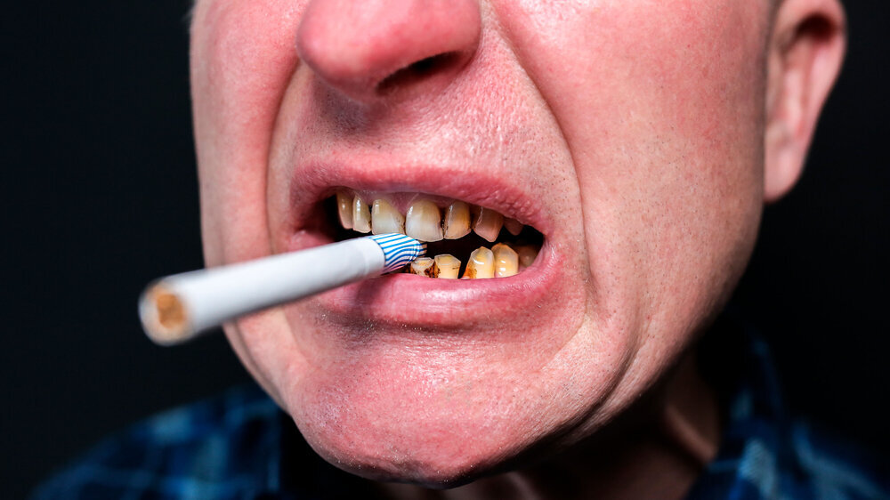 Cigarette in the man's mouth. Plaque teeth cavities and paradontosis. Smoking causes dental decay problems and bad smile. Dentist treatment concept. Harmful habit. Raucher mit Zahnverfärbungen und Parodontitis