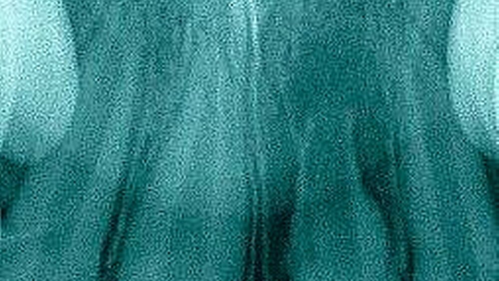 Abbildung 3: Zustand nach Avulsion und Replantation von Zahn 21 durch den Hauszahnarzt: Anamnestisch war zu erfahren, dass der Zahn 21 vor zwei Jahren replantiert worden war. Die extraorale Trockenlagerungszeit hatte etwa 60 Minuten betragen. Die Schienung erfolgte über zwei Jahre rigide durch eine Kunststoffschiene (a). Der klinische Befund zeigt eine apikale Rötung mit Fistel (a) sowie röntgenologisch eine entzündliche Resorption der gesamten Zahnwurzel (b). Außerdem zeigt sich eine diskrete vertikale Wachstumshemmung an Zahn 21 mit einem Weichgewebs-Minus von etwa 1,5 mm im Vergleich zum Nachbarzahn. Durch die rigide Fixierung wird der natürliche Durchbruch des gesunden Zahnes 11 behindert, was klinisch die Ausbildung des bereits sich abzeichnenden frontal offenen Bisses befördert. |