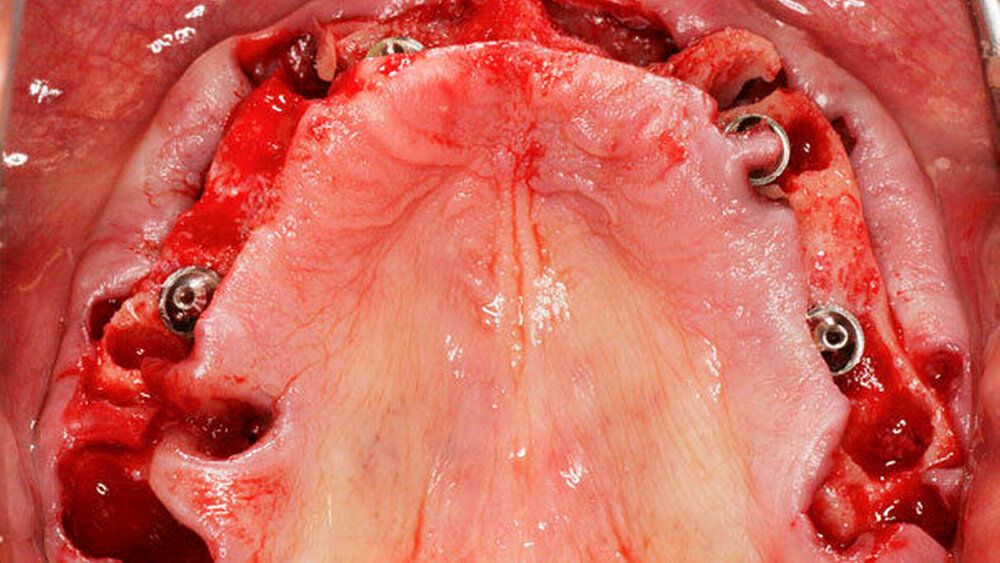 Abbildung 1b) Intraoperative Situation nach Kieferkammresektion und Insertion von vier Nobel Biocare Implantaten. |