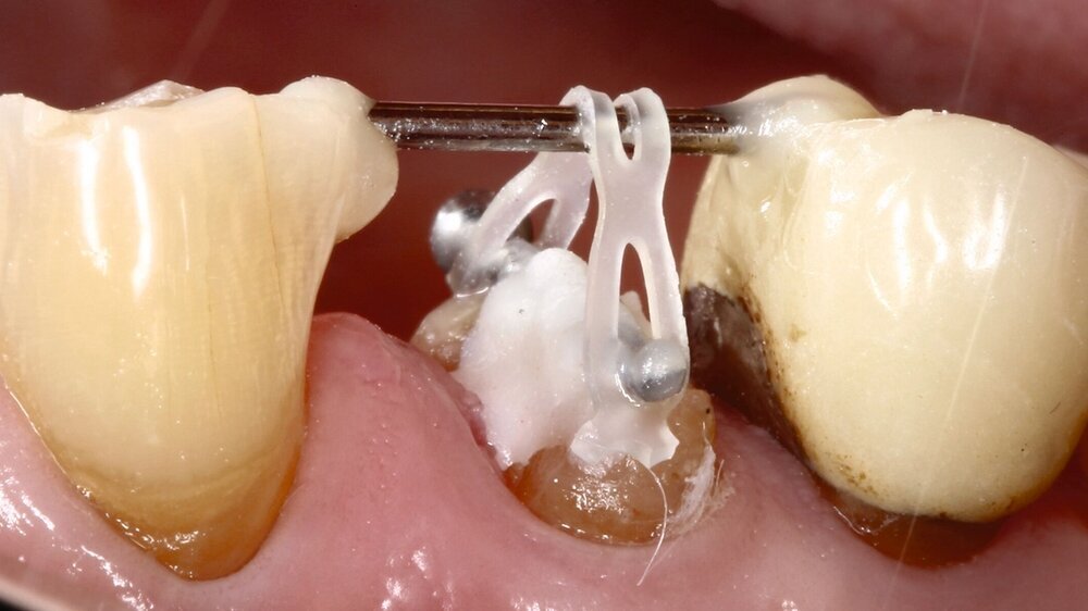 Extrusion eines ersten Prämolaren durch kieferorthopädische Gummizüge