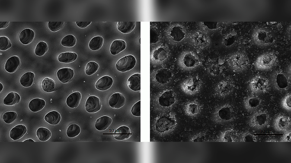 Dentinoberflächen im Rasterelektronenmikroskop: Das obere Bild zeigt die weitgehend offenen Tubuli nach Behandlung mit einer wenig wirksamen Zahnpasta. Im untere Bild sind die Tubuli zum großen Teil verschlossen – hier lässt sich eine gute Desensibil
